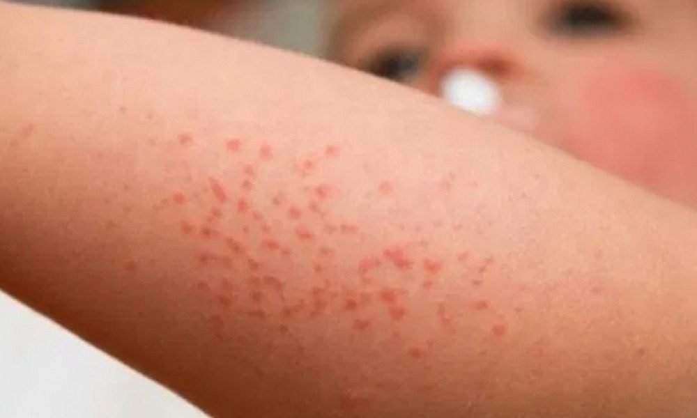 ХӨСҮТ: Менингитийн халдвараар өчигдрийн байдлаар 5 тохиолдол бүртгэгдэж, 1 хүн нас барсан